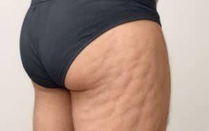 Können Männer Cellulite haben?